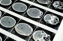 Biotech Advances Revolutionary Treatment for Neurodegenerative Diseases